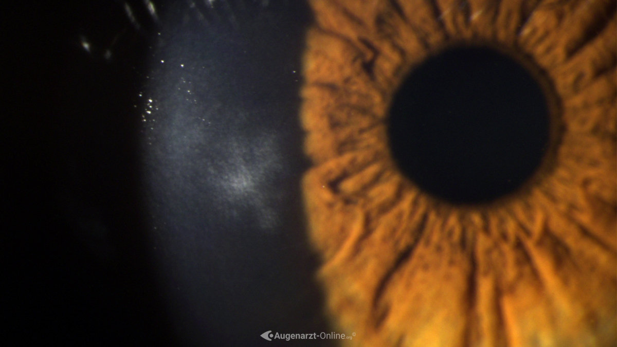 Keratitis dentritica Atlas der Augenheilkunde